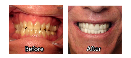 Teeth Whitening Los Angeles